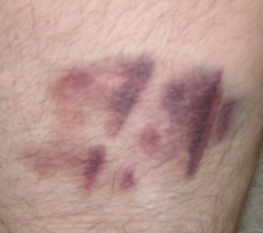 braswell_bruise